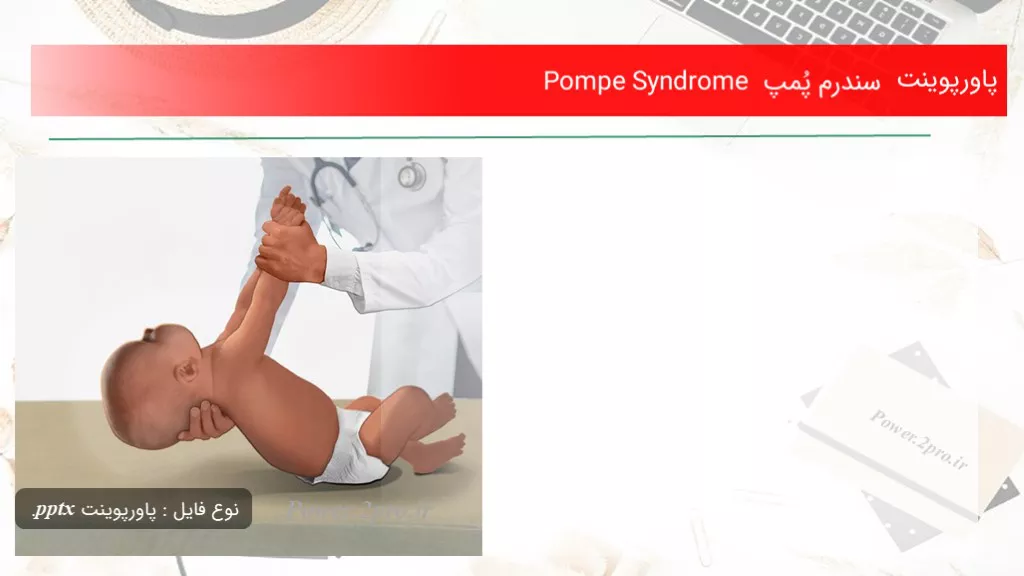 دانلود پاورپوینت سندرم پُمپ Pompe Syndrome - کد117735