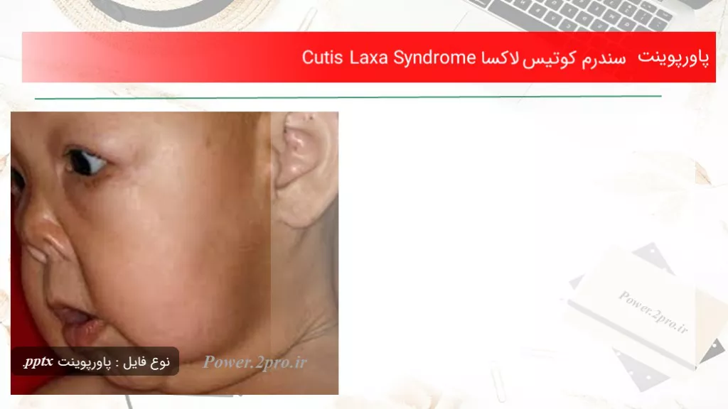 دانلود پاورپوینت سندرم کوتیس لاکسا Cutis Laxa Syndrome - کد117738