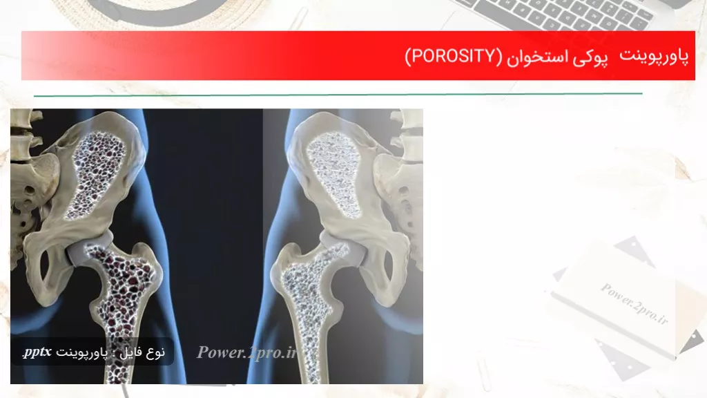 دانلود پاورپوینت پوکی استخوان (POROSITY) - کد117854