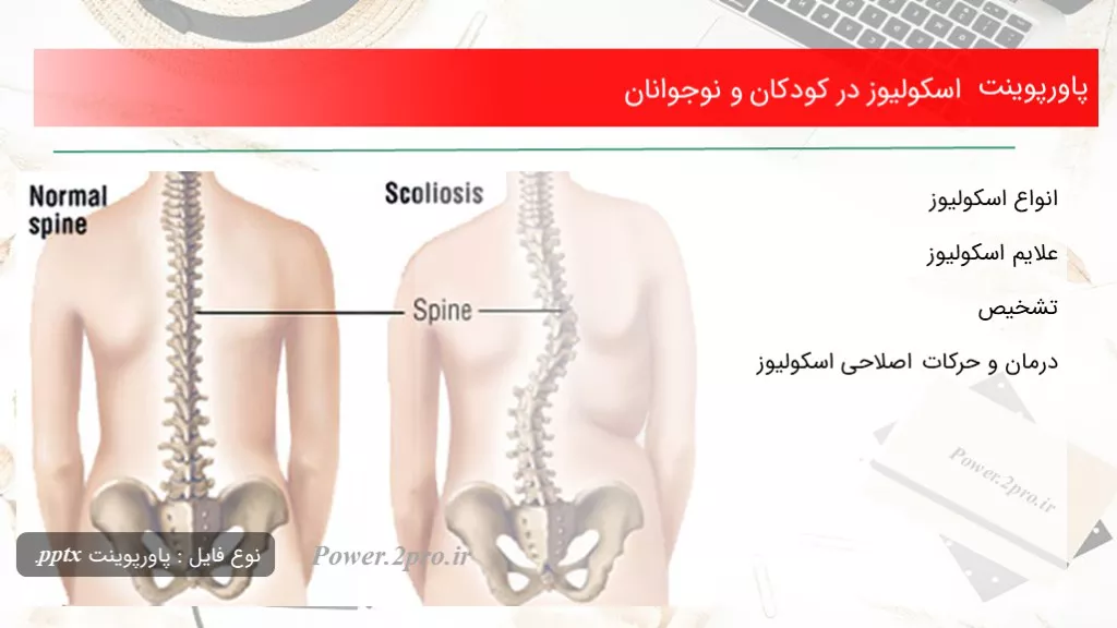 دانلود پاورپوینت اسکولیوز در کودکان و نوجوانان - کد118160