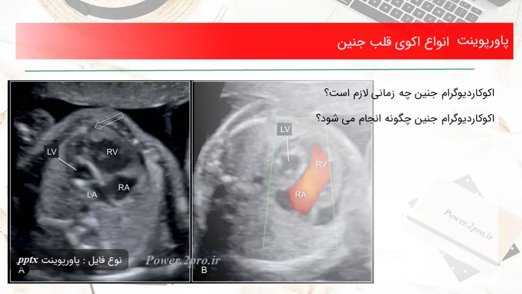 دانلود پاورپوینت انواع اکوی قلب جنین - کد118245