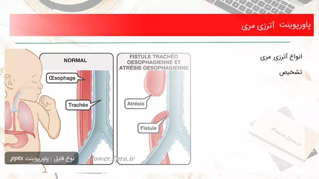 دانلود پاورپوینت آترزی مری - کد118315