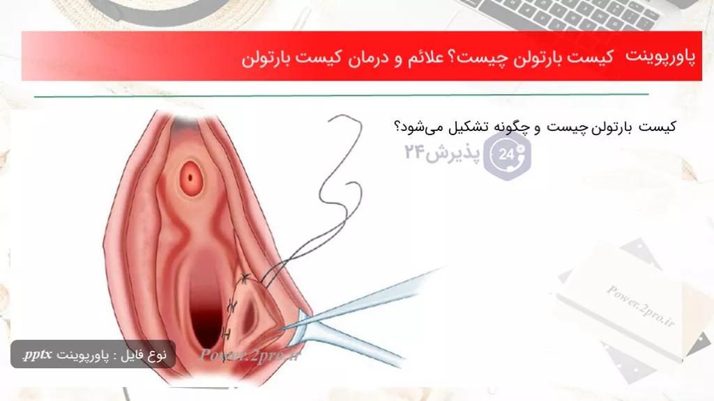 دانلود پاورپوینت کیست بارتولن چه چیزی است ؟ علائم و درمان کیست بارتولن - کد118691