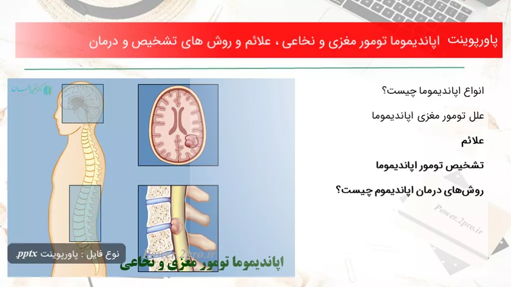 دانلود پاورپوینت اپاندیموما تومور مغزی و نخاعی ، علائم و چگونگی های تشخیص و درمان - کد119010