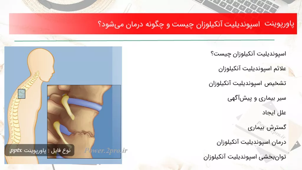 دانلود پاورپوینت اسپوندیلیت آنکیلوزان چه چیزی است و  چطور درمان می‌شود؟ - کد119015