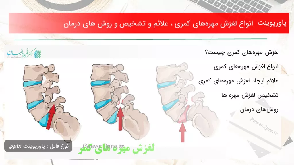 دانلود پاورپوینت انواع لغزش مهره‌های کمری ، علائم و تشخیص و چگونگی های درمان - کد119028