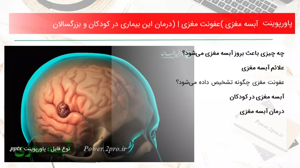 دانلود پاورپوینت آبسه مغزی (عفونت مغزی) | درمان این بیماری در کودکان و بزرگسالان - کد119034