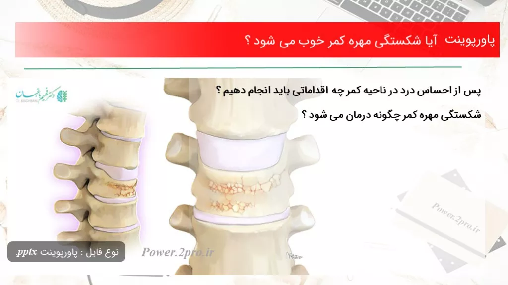 دانلود پاورپوینت آیا شکستگی مهره کمر خوب می شود ؟ - کد119063