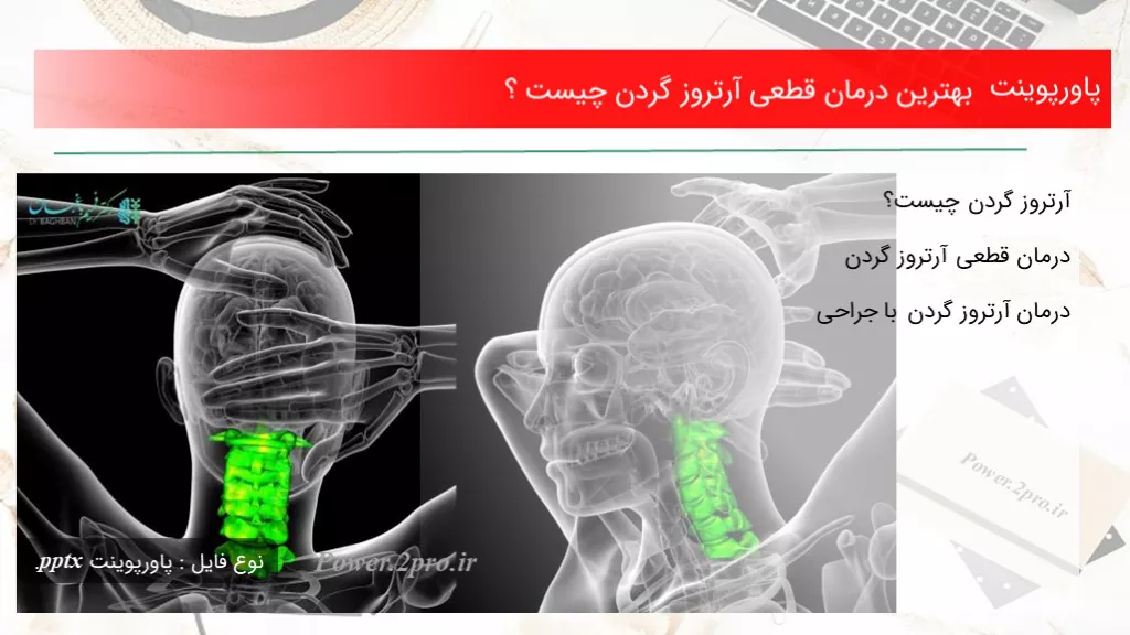 دانلود پاورپوینت بهترین درمان قطعی آرتروز گردن چه چیزی است ؟ - کد119088