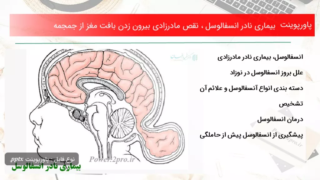 دانلود پاورپوینت بیماری نادر انسفالوسل ، نقص مادرزادی بیرون زدن بافت مغز از جمجمه - کد119099