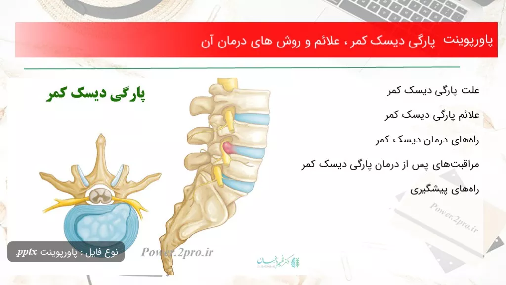 دانلود پاورپوینت پارگی دیسک کمر ، علائم و چگونگی های درمان آن - کد119100