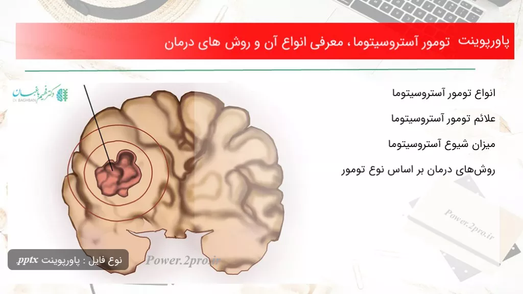 دانلود پاورپوینت تومور آستروسیتوما ، معرفی انواع آن و چگونگی های درمان - کد119121