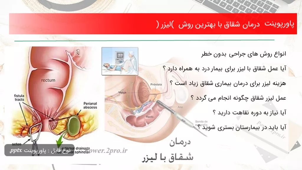 دانلود پاورپوینت درمان شقاق با بهترین چگونگی ( لیزر ) - کد119213