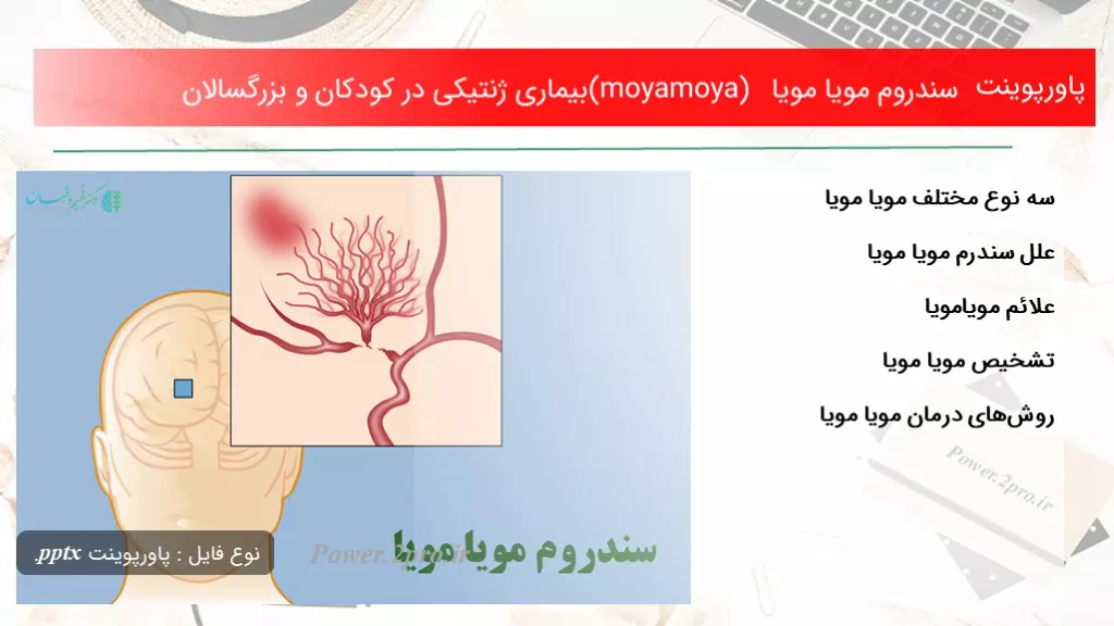 دانلود پاورپوینت سندروم مویا مویا (moyamoya) بیماری ژنتیکی در کودکان و بزرگسالان - کد119249