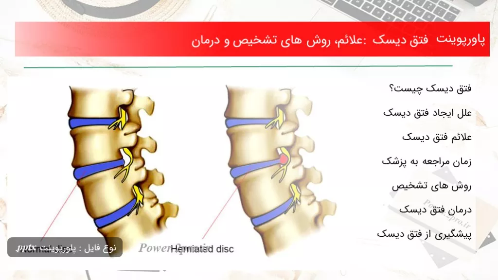 دانلود پاورپوینت فتق دیسک : علائم، چگونگی های تشخیص و درمان - کد119288