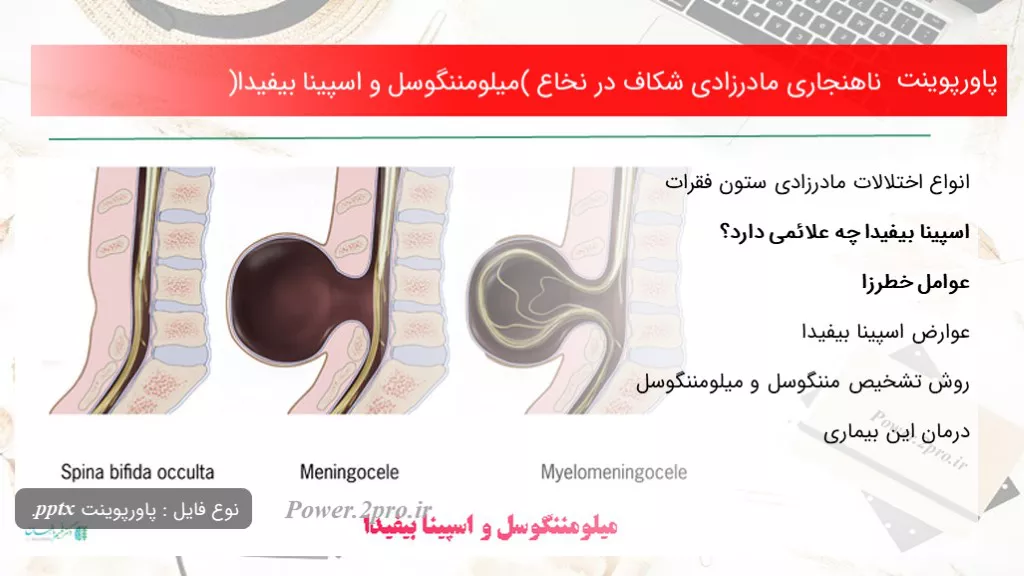 دانلود پاورپوینت ناهنجاری مادرزادی شکاف در نخاع (میلومننگوسل و اسپینا بیفیدا) - کد119325